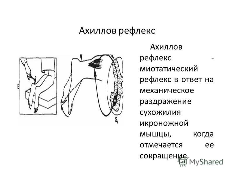 Ахиллов рефлекс схема