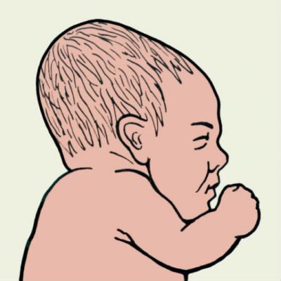 Деформации черепа у новорожденных детей