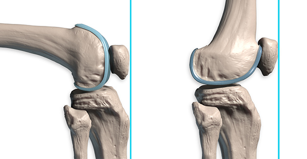 Patella placement as knee bends